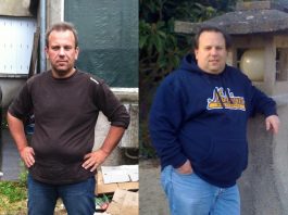 Photo d'un homme avant et après une sleeve gastrique.