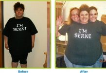 Photo avant après l'opération de bypass gastrique.