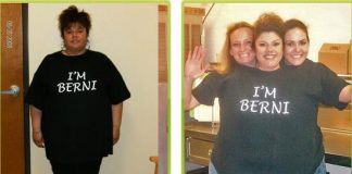 Photo avant après l'opération de bypass gastrique.