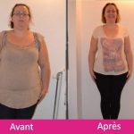 Sleeve gastrectomie : tout savoir en 6 points