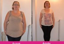 Sleeve gastrectomie : tout savoir en 6 points